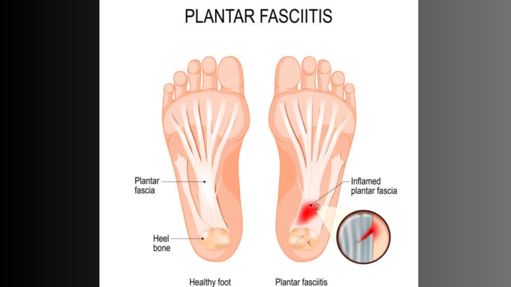 Heel Pain